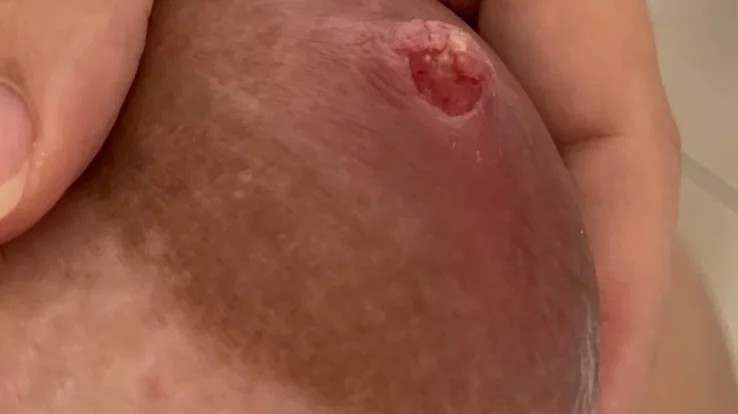Understanding Nipple Cracks During Breastfeeding